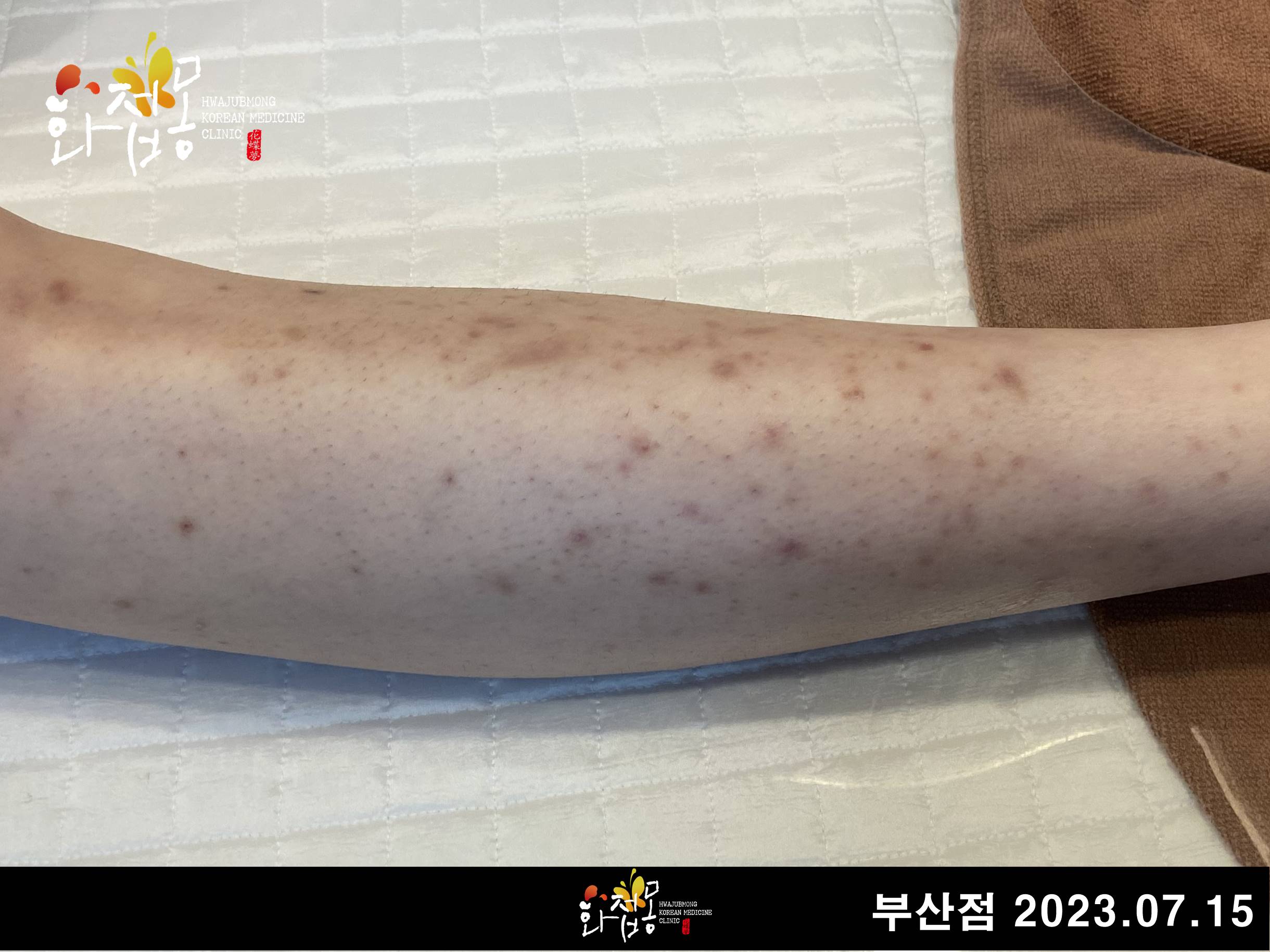 전후사진