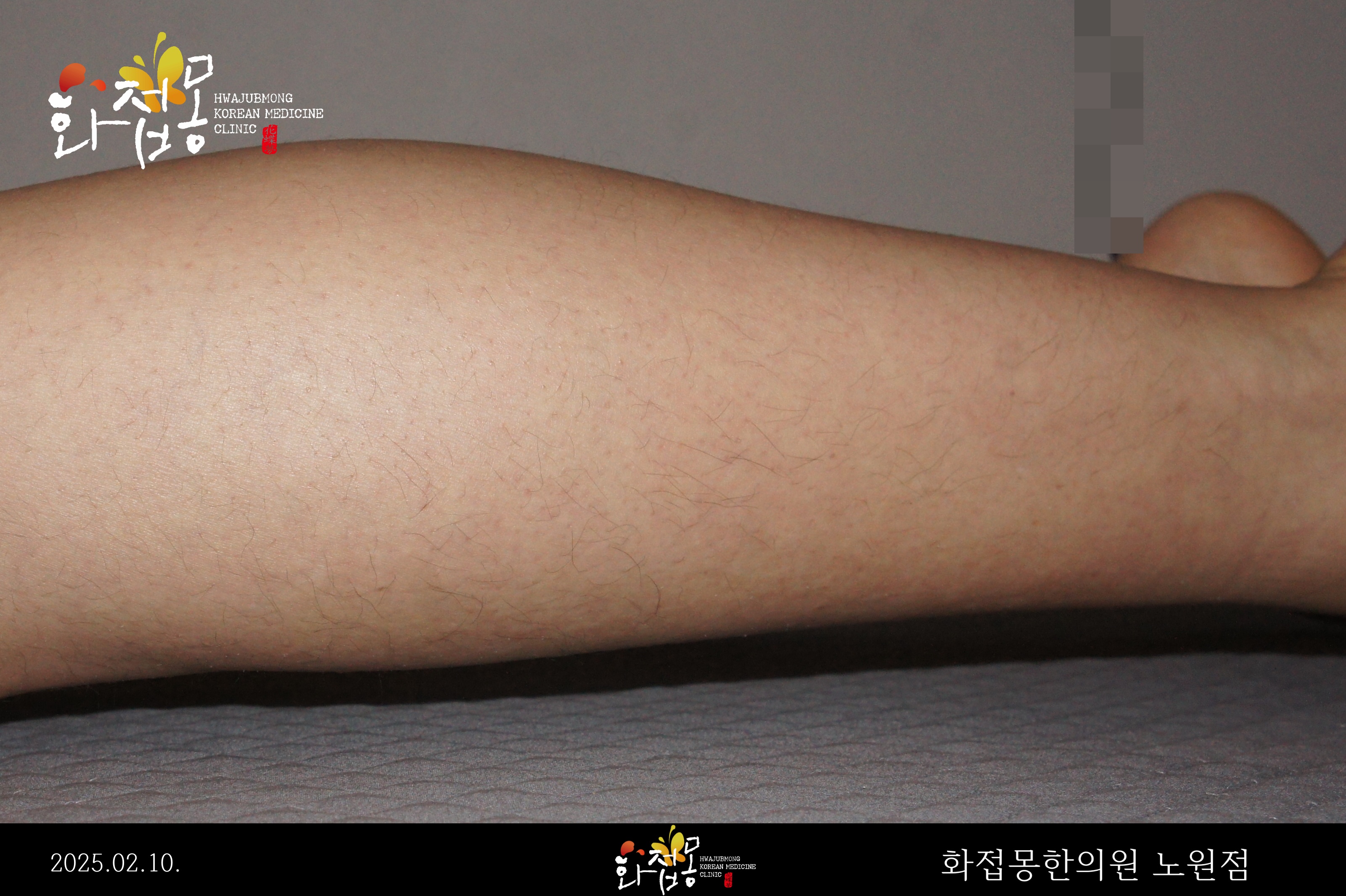 전후사진