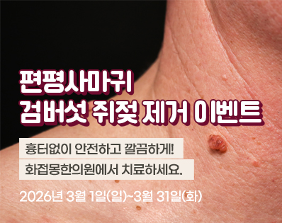 편평사마귀 _29이벤트