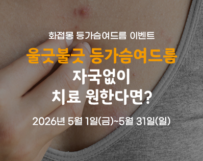 등가슴여드름_이벤트