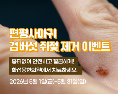 편평사마귀 _39이벤트