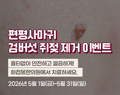 편평사마귀 _29이벤트