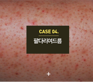 여드름